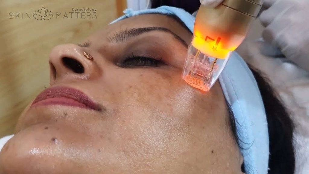 Why Sylfirm X Is The Best Pimple Scar Treatment